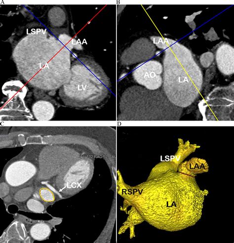 Application Of Cardiac Computed Tomographic Imaging And Fluoroscopy