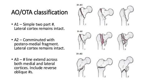 Intertrochanteric Fractures of Femur