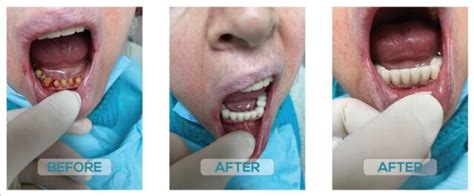 Gallery Zx 27 Non Surgical Dental Implants Alternative