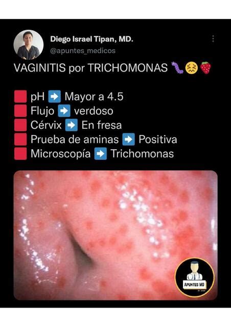 Vaginitis por trichomonas Apuntes Médicos Dr Israel Apuntes