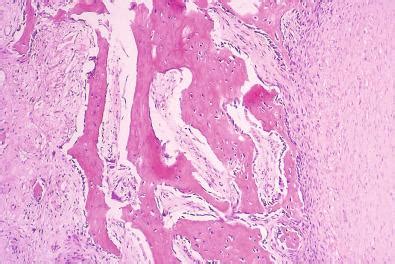 Cartilaginous and Osseous Soft Tissue Lesions - Clinical Tree