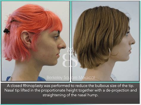 Best Rhinoplasty Surgeon London Top Rhinoplasty Surgeons Uk