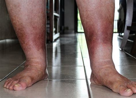 Red Legs Membedakan Selulitis Dari Penyebab Lain Alomedika