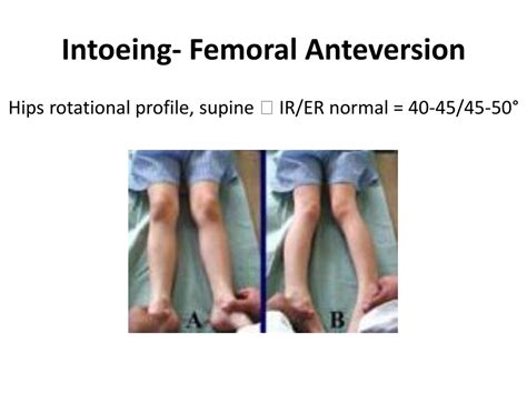 PPT - Common Pediatric Lower Limb Disorders PowerPoint Presentation