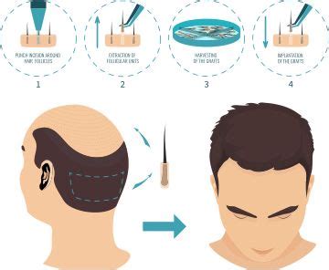 Microinjerto Capilar Clinica Menorca Hair Transplant In India Hair