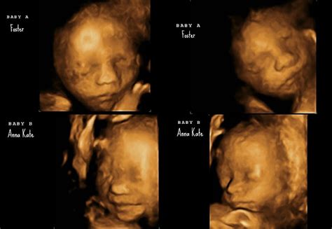 At Last Twins 26 Weeks And 4d Ultrasounds