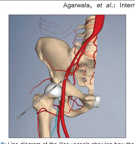 Figure From Internal Iliac Artery Pseudoaneurysm In Primary Total Hip