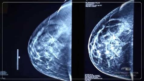 Shaw Breast Center And Cancer Clinic 3d Mammography Youtube