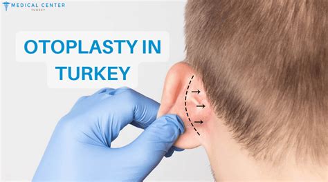 Otoplasty In Turkey Medical Center Turkey