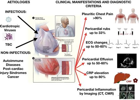 Pericarditis Symptoms