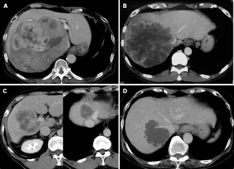 Figure 1 From Retrocaval Liver Lifting Maneuver And Modifications Of