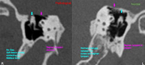 Tegmen Tympani Dehiscence
