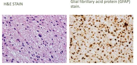 Cns Neoplasms E Flashcards Quizlet