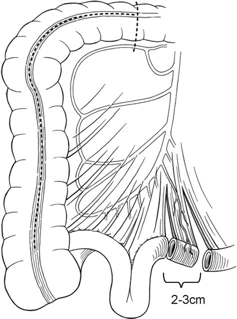 Application Of The Yang Monti Channel In Adult Continent Cutaneous