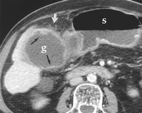 Ct Findings In Acute Gangrenous Cholecystitis Ajr