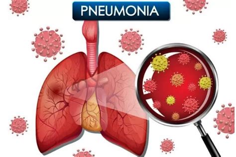 6 Tips Cegah Penularan Bakteri Mycoplasma Pneumoniae Bicara Network