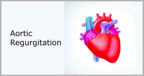 Aortic Valve Regurgitation Life Expectancy