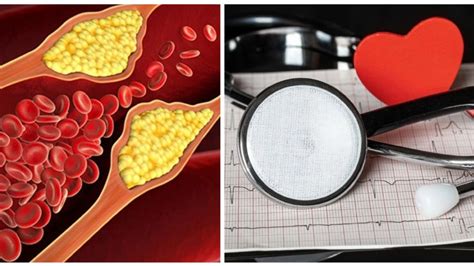 Triglicéridos Y Colesterol 4 Síntomas De Alerta De Niveles Altos El