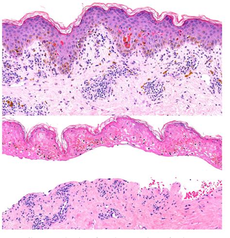 Figure From A Review Of Fixed Drug Eruption With A Special Focus On