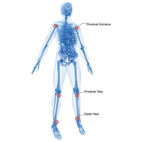 Arrow® EZ-IO® Manual Needle Set | Intraosseous Access | Vascular Access ...