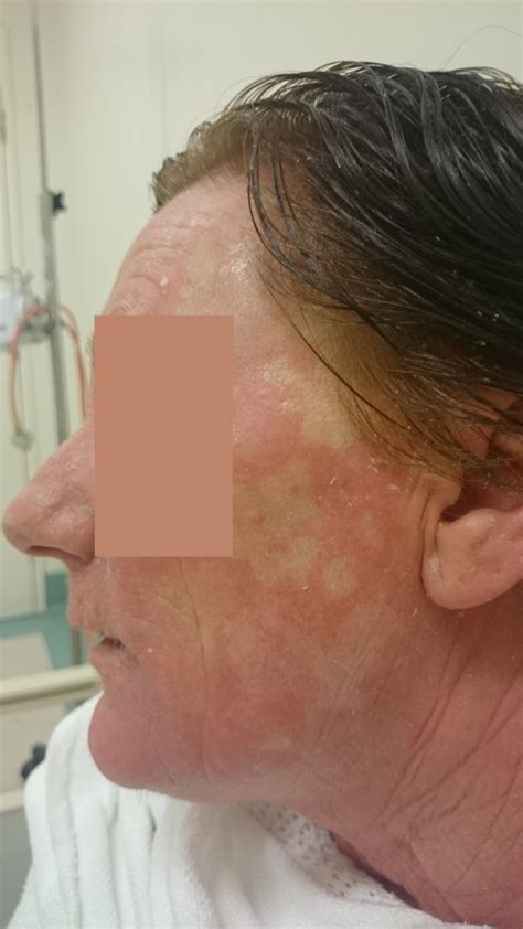 Acd A Z Of Skin Pityriasis Rubra Pilaris