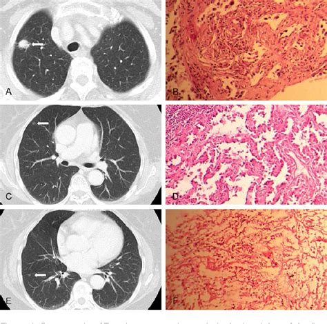 Figure 1 From Single Stage Surgical Treatment Of Synchronous Multiple Primary Lung Cancers A