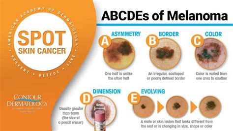 Skin Cancer | Sunscreen | Self Check | Contour Dermatology