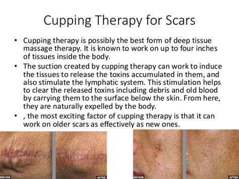 Cupping Therapyforskindiseases