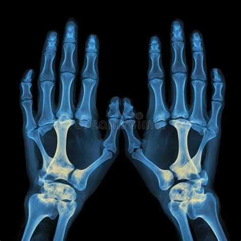 X-ray Image of Hand Bones, Anatomy, Human Body Stock Illustration ...