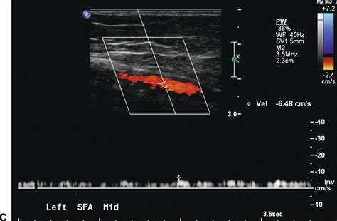 Lower Extremity Arterial Ultrasound Criteria