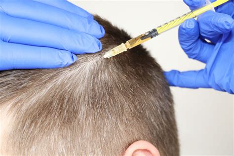 Scalp Mesotherapy IHairMed