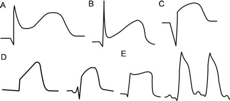 In The Acute Phase Of St Segment Elevation Myocardial Infarction Download Scientific Diagram