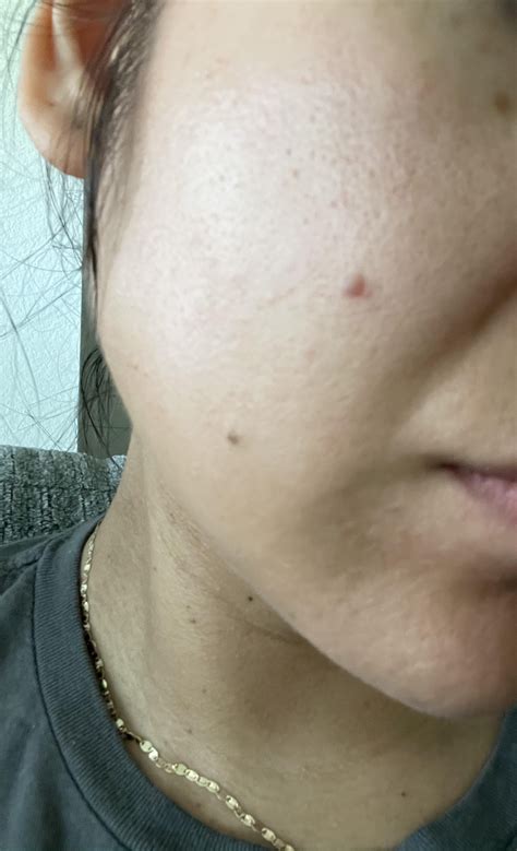 Random Bump On Face Not Acne R30plusskincare