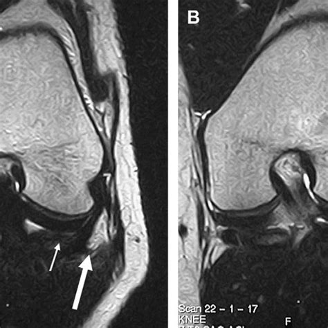 ( A, B ) Fracture of Gerdy’s tubercle. Sagittal ( A ) T2-weighted MR ...