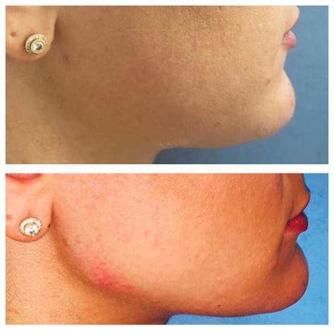 Dr Todd On Instagram Want A Tighter Jawline Patient Wanted A