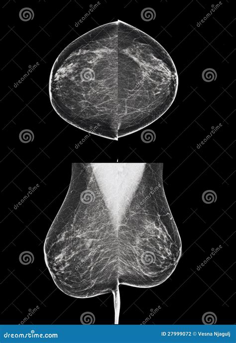 Screening For Breast Cancer - Mammogram Stock Photography - Image: 27999072