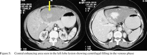 A rare case of atypical hemangioma showing centrifugal enhancement