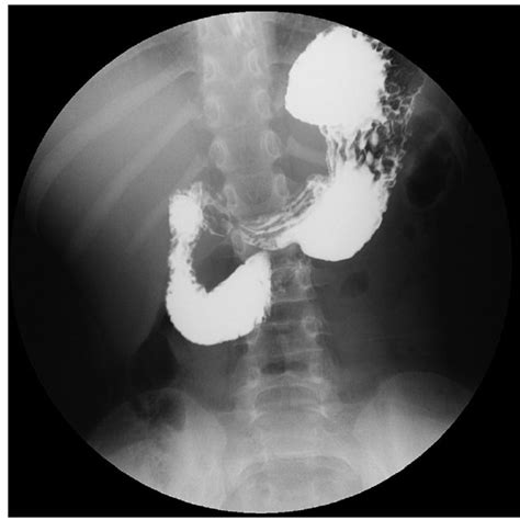 Upper Gastrointestinal Series Shows Abrupt Vertical Or Oblique Cutoff