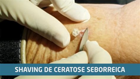 Ceratose Seborreica Ep 02 Remoção por shaving YouTube