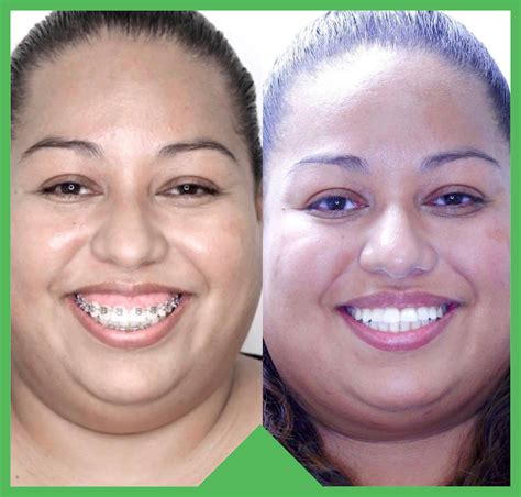 Gummy Smiles Treatment In Encino Ca Orthodontics La