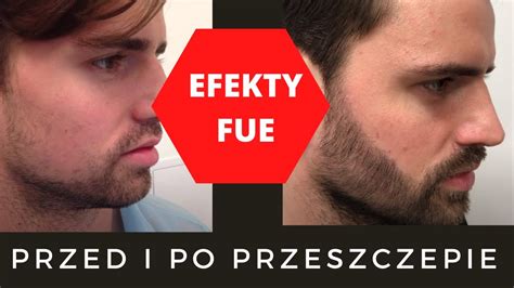 Przed I Po Przeszczep W Os W Efekty Przeszczep Fue Youtube