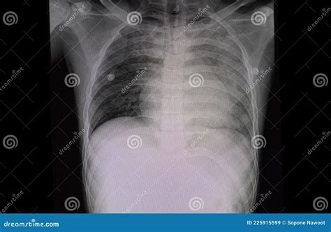 Chest X Ray Film Of A Patient With Cardiomegaly And Pulmonary Edema