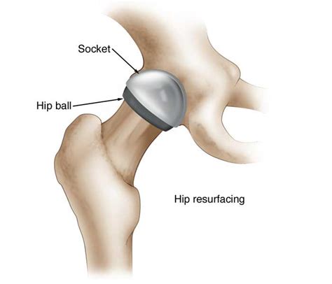 Hip Resurfacing And Orthopaedic Surgery Bristol Hip Surgeon