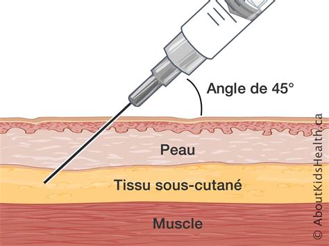 Injections Sous Cutanées Comment Les Administrer à La Maison En 2024