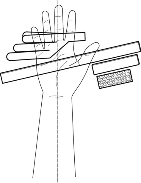 Guide Ulnar drift splint