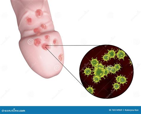 Lésions De Virus D herpès Génital Illustration Stock Illustration du