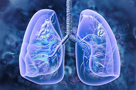 Fda Approves Osimertinib Plus Chemo For Egfr Mutated Advanced Nsclc