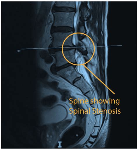 Spinal stenosis - Rajiv Bajekal