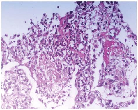 Formation Of Fibrinoid Necrosis Download Scientific Diagram