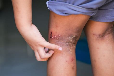 How To Treat Eczema On Elbows